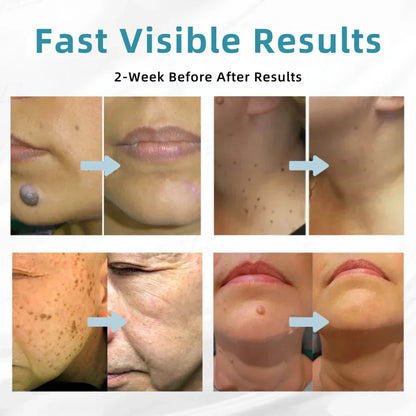 ☂DedMuller® VelvetSkin+Series ⚔️All-in-One Laser Eraser Pen🖊️ (🔬Powered by CO₂ laser technology – effectively removes moles, warts, skin tags, pigmentation spots, and other skin imperfections)